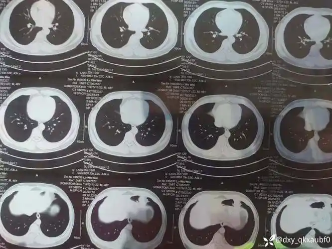 右侧心膈角处高密度灶