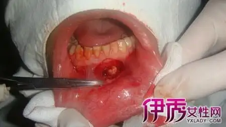 【图】严重的牙龈囊肿图片 如何预防牙龈囊肿?