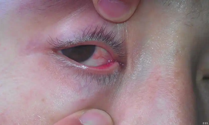 右眼球结膜内侧充血不退原因