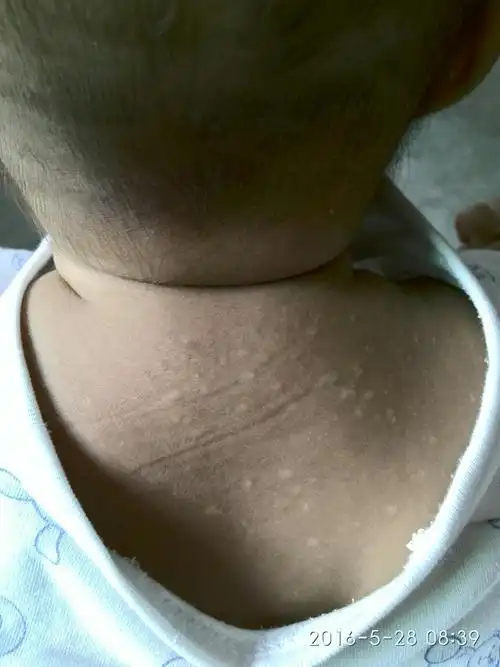 求助,宝宝长汗斑了