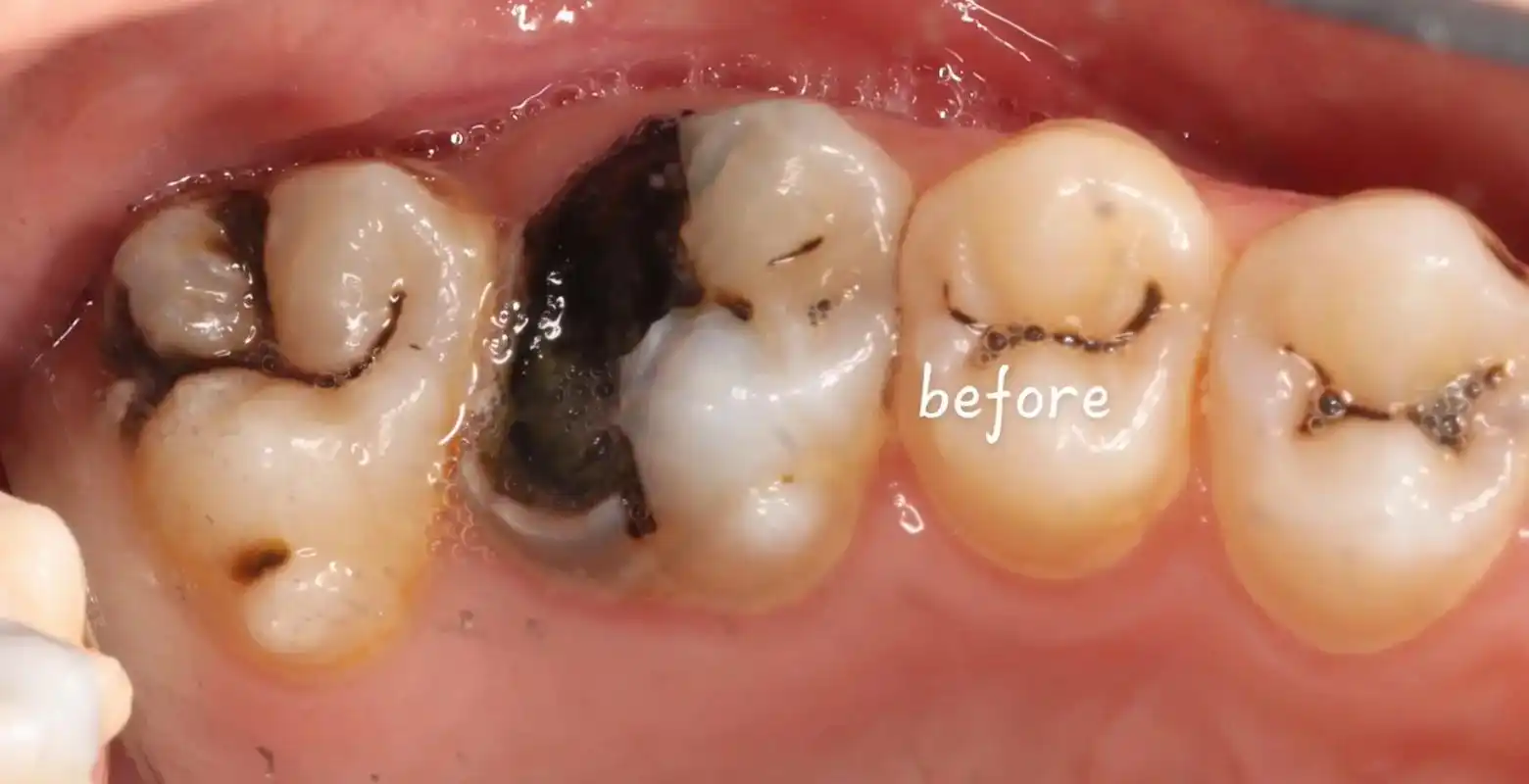 六龄齿一般在6岁左右萌出处于替牙期新老交替期间是特别容易蛀牙的稍