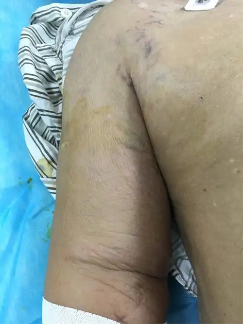 右上肢肿胀病例1例