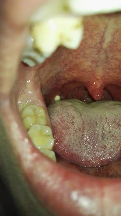 如图,口腔内壁长了一个白色的疙瘩,不痛不痒,就有一点异物感,请问是