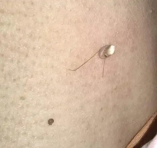 医生:极易传染,尽早医治|丝状疣|脖子|医生_新浪新闻