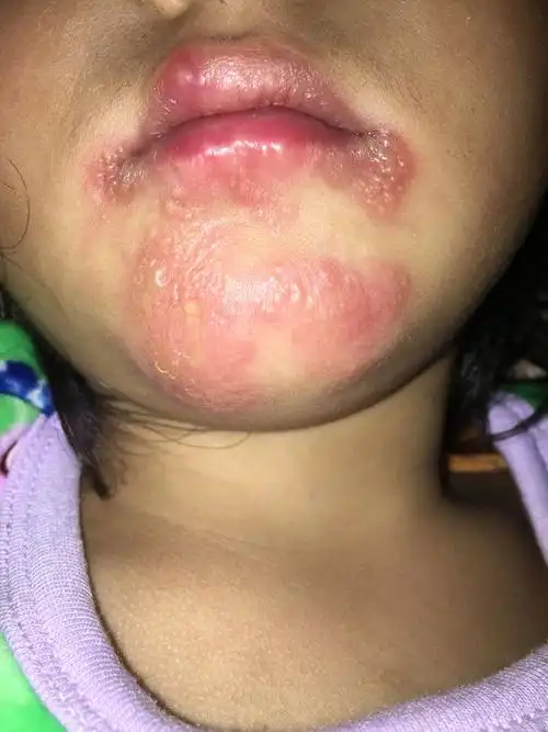 我宝宝从一岁多开始到现在三岁半,每次发烧过后下巴嘴唇都是长水泡,这