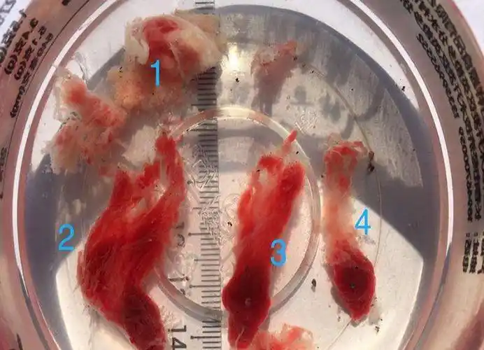 子宫内膜息肉排出图片1