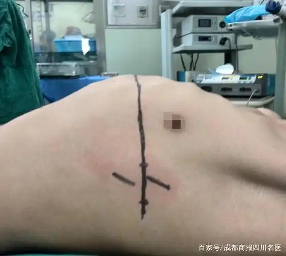 3肋软骨到第7肋软骨向内凹陷变形,胸骨,肋软骨及一部分肋骨向脊柱凹陷