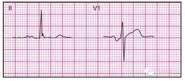 最全面的异常心电参考图建议收藏