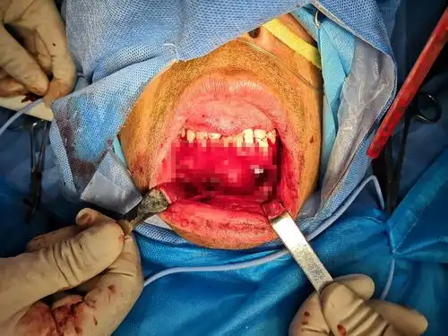 口腔外科方面:下颌骨巨大囊肿切除术手术中完整剥离囊壁.