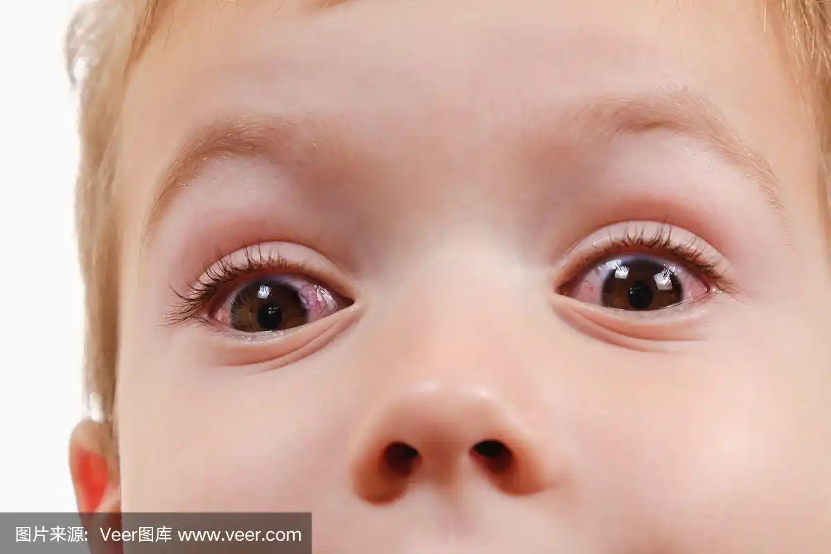 儿童红眼结膜炎伴有感染,病毒.