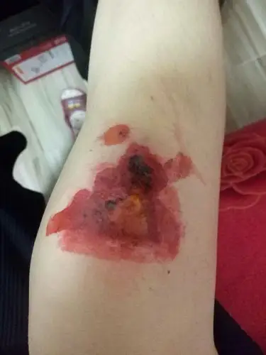 膝盖摔了两天不走路也有点疼