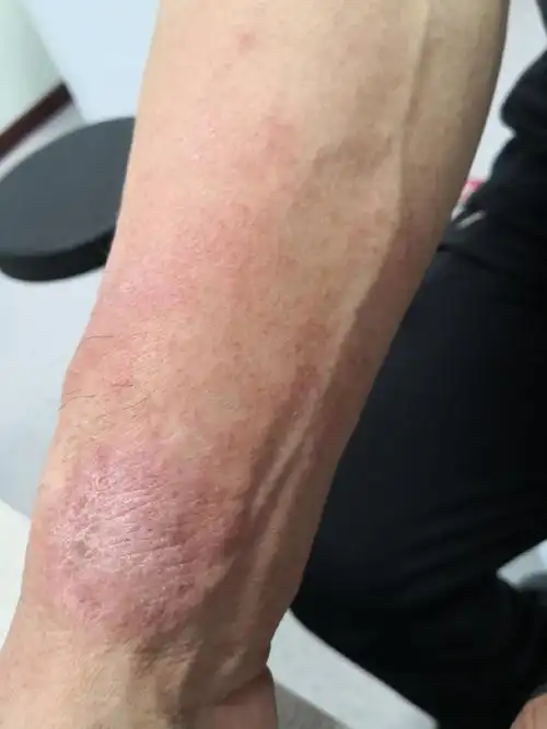 考虑日光性皮炎症状.#解决皮肤问题专注皮肤美容##紫外线过敏