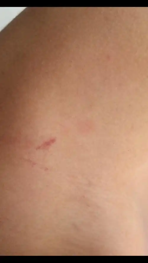 这是虫咬的26% 这是吻痕74%          1012 人参与