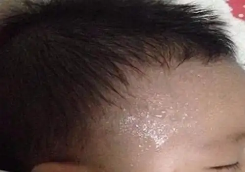 而实际上,儿童若在睡觉或活动量大一些就出汗多,大多数属于正常症