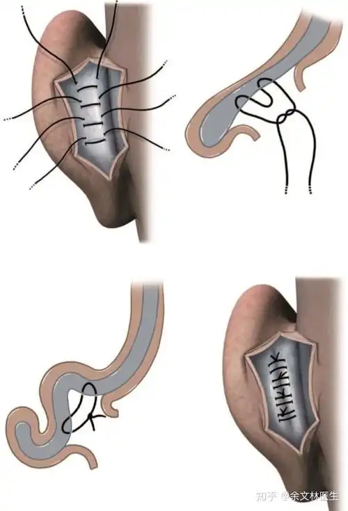 三角窝线,用针头或套管针做标记,耳廓后表面用亚甲蓝在软骨膜表面标记