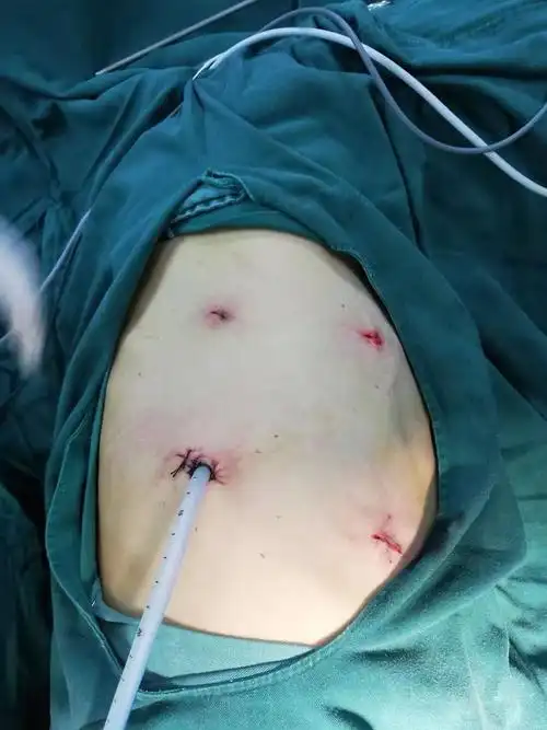 再登新高——临沧市二院成功开展胸腹腔镜联合食管癌根治术