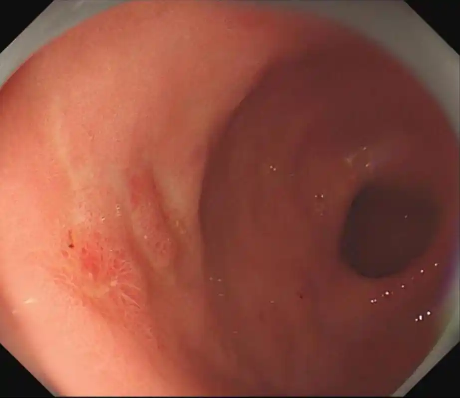 早期胃癌的微创治疗