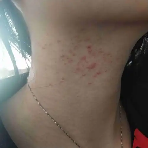 脖子两边得了毛囊炎怎么办?