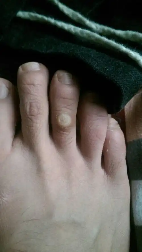 脚趾上凸起了一个硬硬的疙瘩,像是老茧,有什么方法能消除吗?