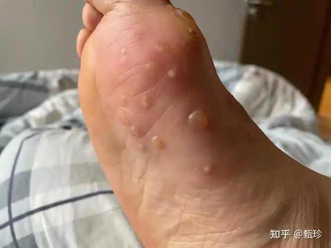 痛也要忍着,跖疣治疗的好方法