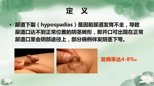 小儿尿道下裂是怎么回事什么是小儿尿道下裂