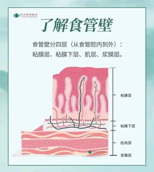 做胃镜检查,发现"食管黏膜下隆起",怎么回事?_内镜_粘膜_手术