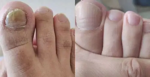 指甲变黄,增厚的注意了!