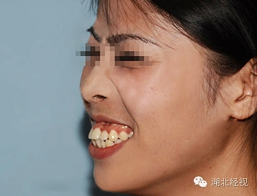 30岁,一个女人最好的年华,她却因龅牙黑牙错失婚姻…全省寻找