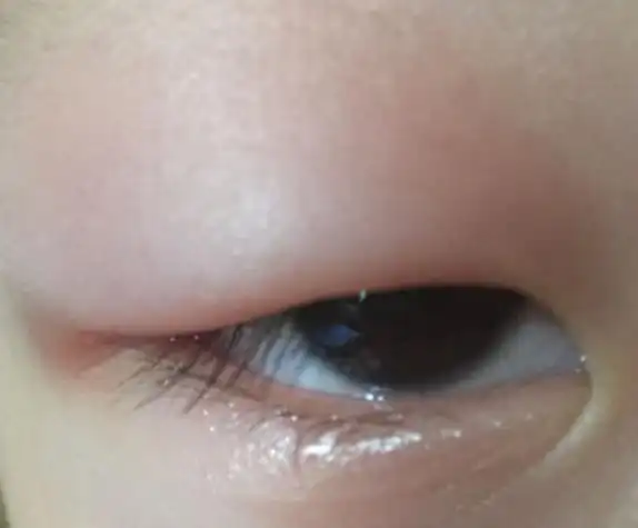 孩子起床后眼皮红肿是咋回事?