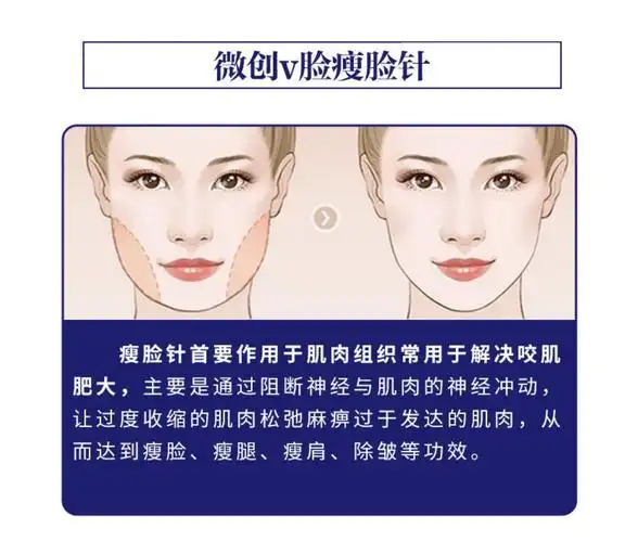 量足【v脸下颌缘】兰州衡力80u肉毒素 提升 精致圆润v脸