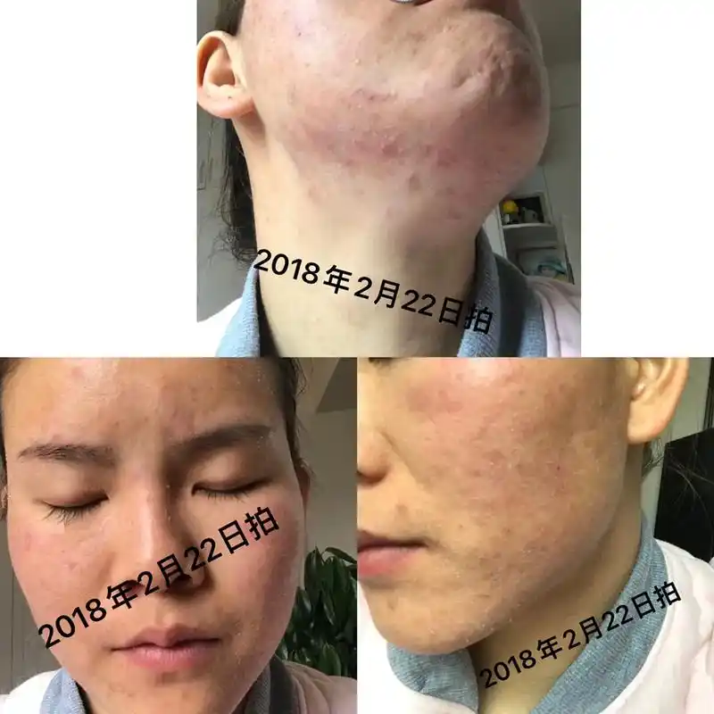 皮肤病 我就想问问这个还能治嘛 #白塞病 如果不能治长期下 - 抖音