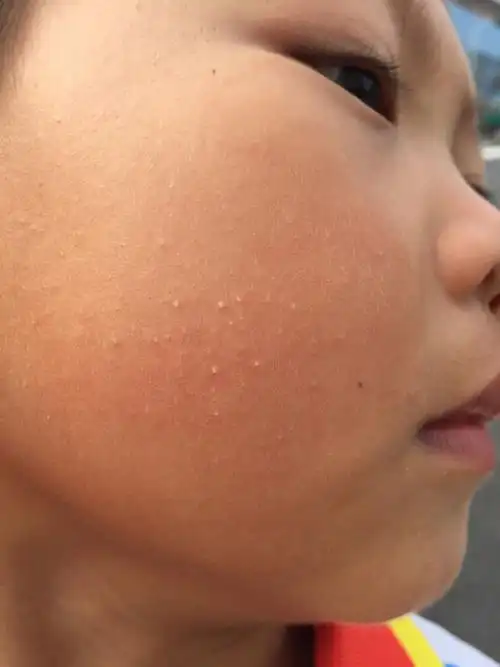 小孩子脸上起了很多白色的小痘痘,像粉刺一样.请问是怎么回事呢?