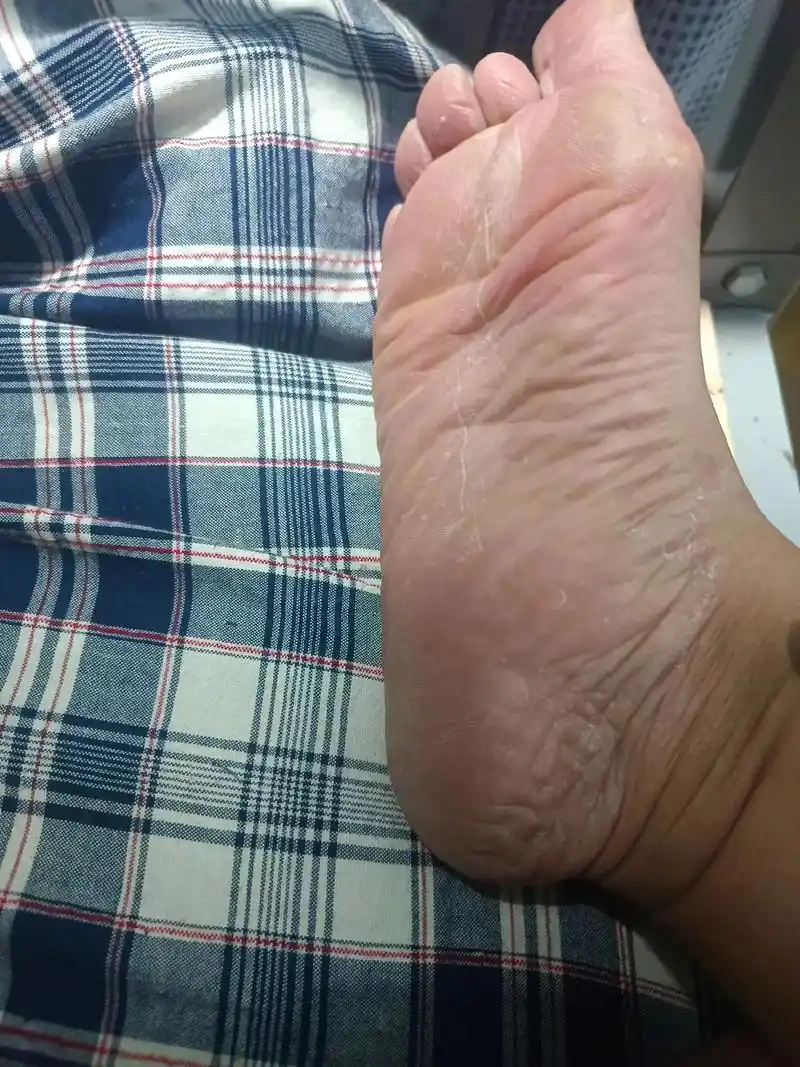 只能说可伶我的一双脚!跑来跑去累得老茧,一个人守两个塔吊,外 - 抖音