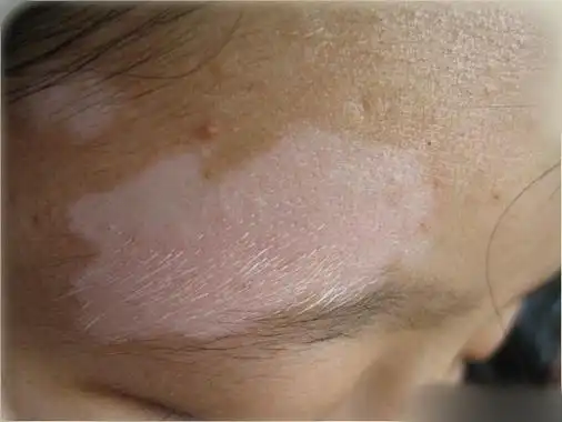 蛔虫脸上白斑图片