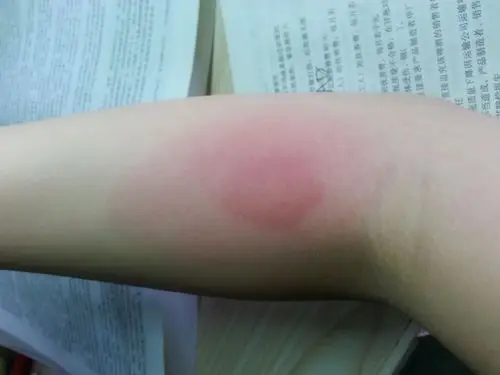 被蚊子叮的像荷包蛋(中间特别红,外面还泛着一圈红色),有点痒,按了有