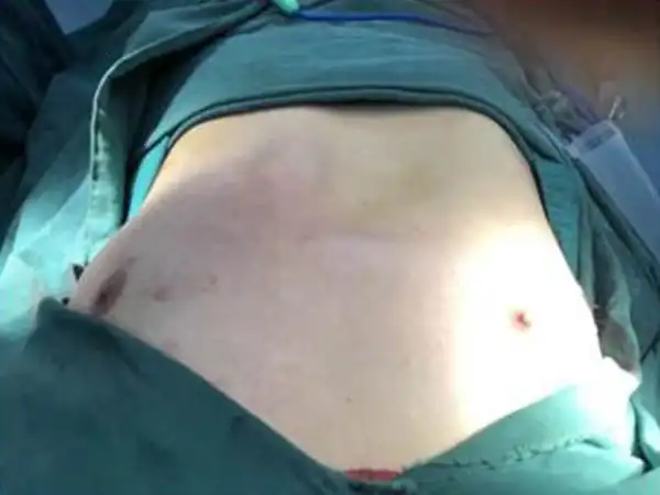 小孩鸡胸能看到胸骨是突出来的