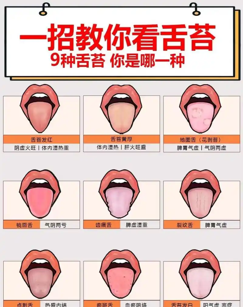 常见的9种舌苔图,看看你是哪一种?