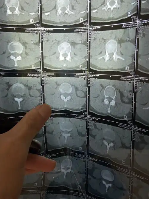 腰椎骨折日记二