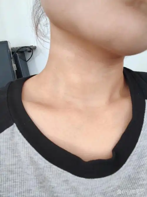 脖子黑一块白一块怎么回事