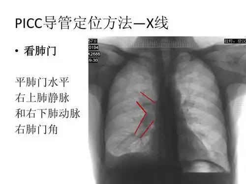 picc导管定位方法—x线   看肺门 平肺门水平