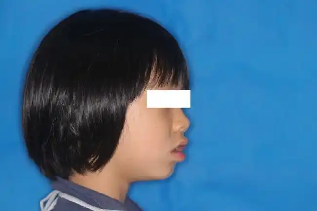 小孩子牙齿不齐错颌畸形怎么办