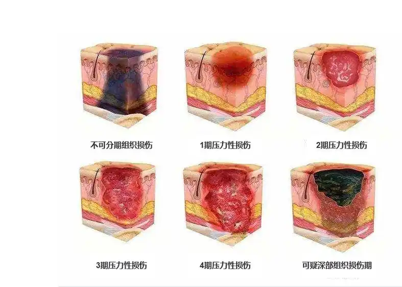 压疮分期标准(最新)