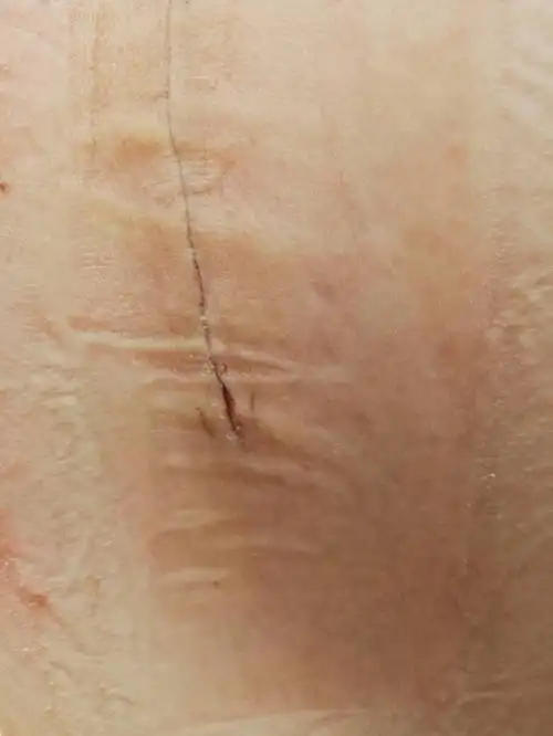 请大家帮忙看看刨妇产手术后第八天的伤口愈合,还需不需要做什么特殊