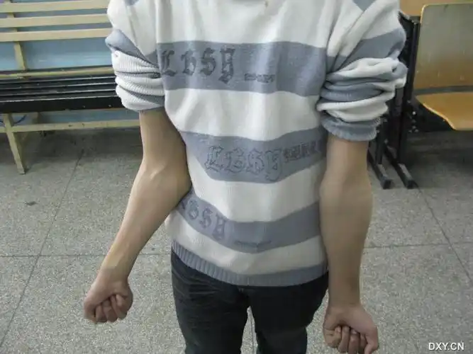 如此肘外翻 患者男18岁10年右肘外伤未治疗,近3年右肘外翻畸行加重,但