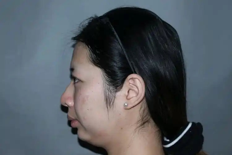 其实之前没有觉得我下巴有那么短那么难看,还是陪朋友_圈子-新氧美容