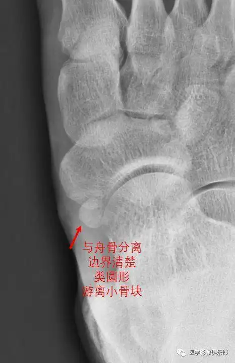 足副舟骨痛综合征