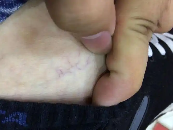 我的脚为啥这里的血管这样的?不痛不痒没任何感觉,就是清晰可见!
