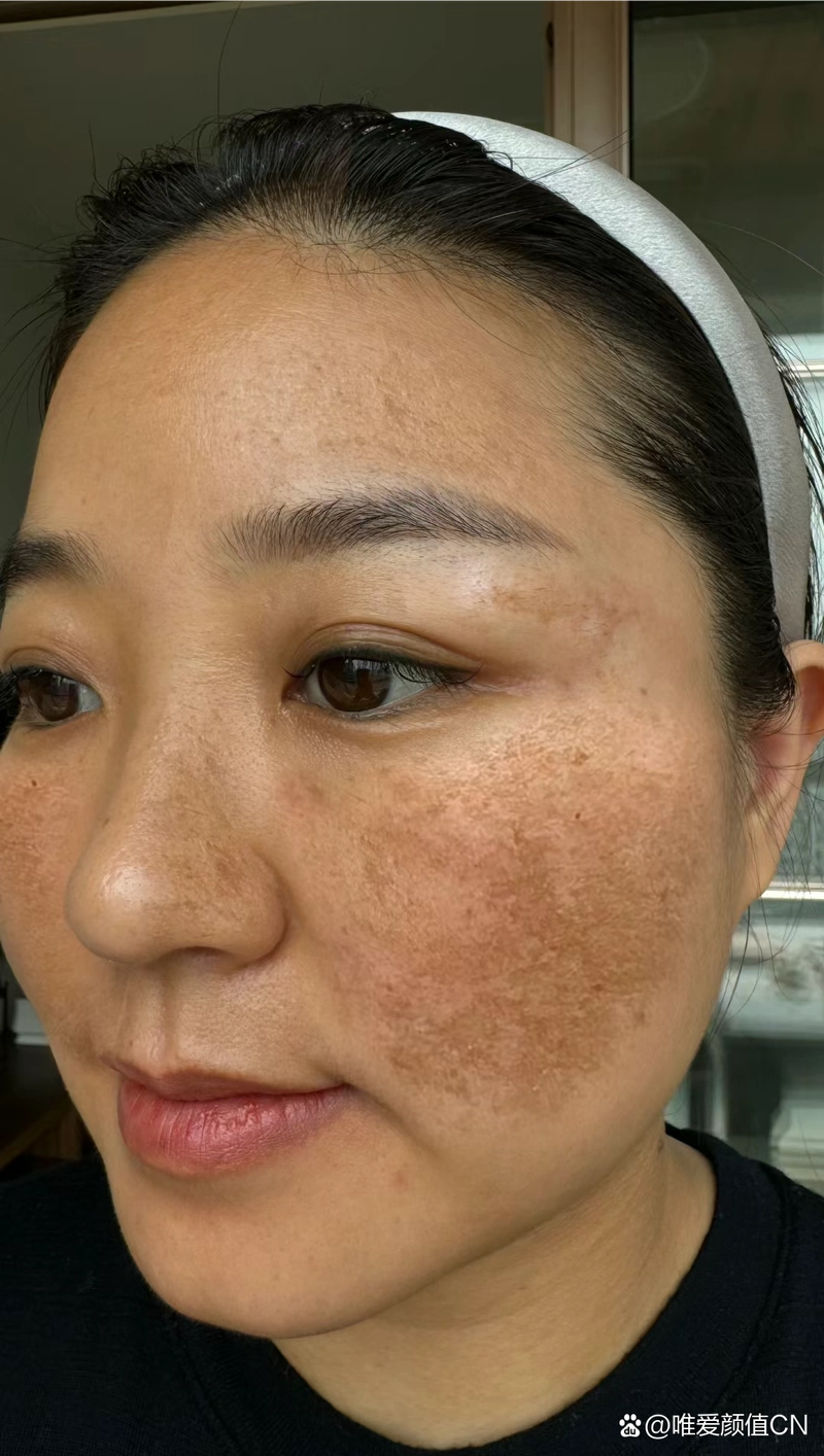 后来结完婚生完孩子之后越来越严重,长了一脸黄褐斑,用过激光还是反黑