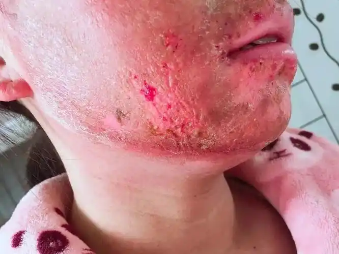 年轻女子面部烧伤,原因竟然是