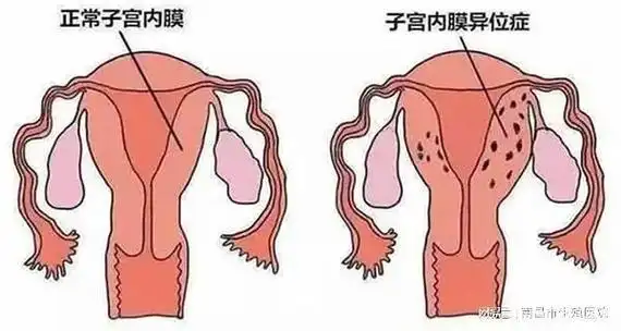 子宫内膜异位症能做试管婴儿吗?|囊肿|盆腔_网易订阅